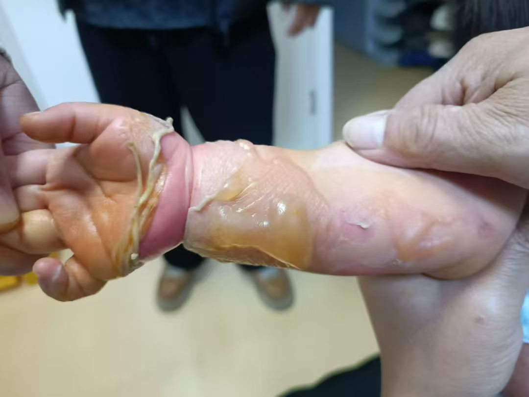 小朋友开水烫伤修复案例 治疗前照片