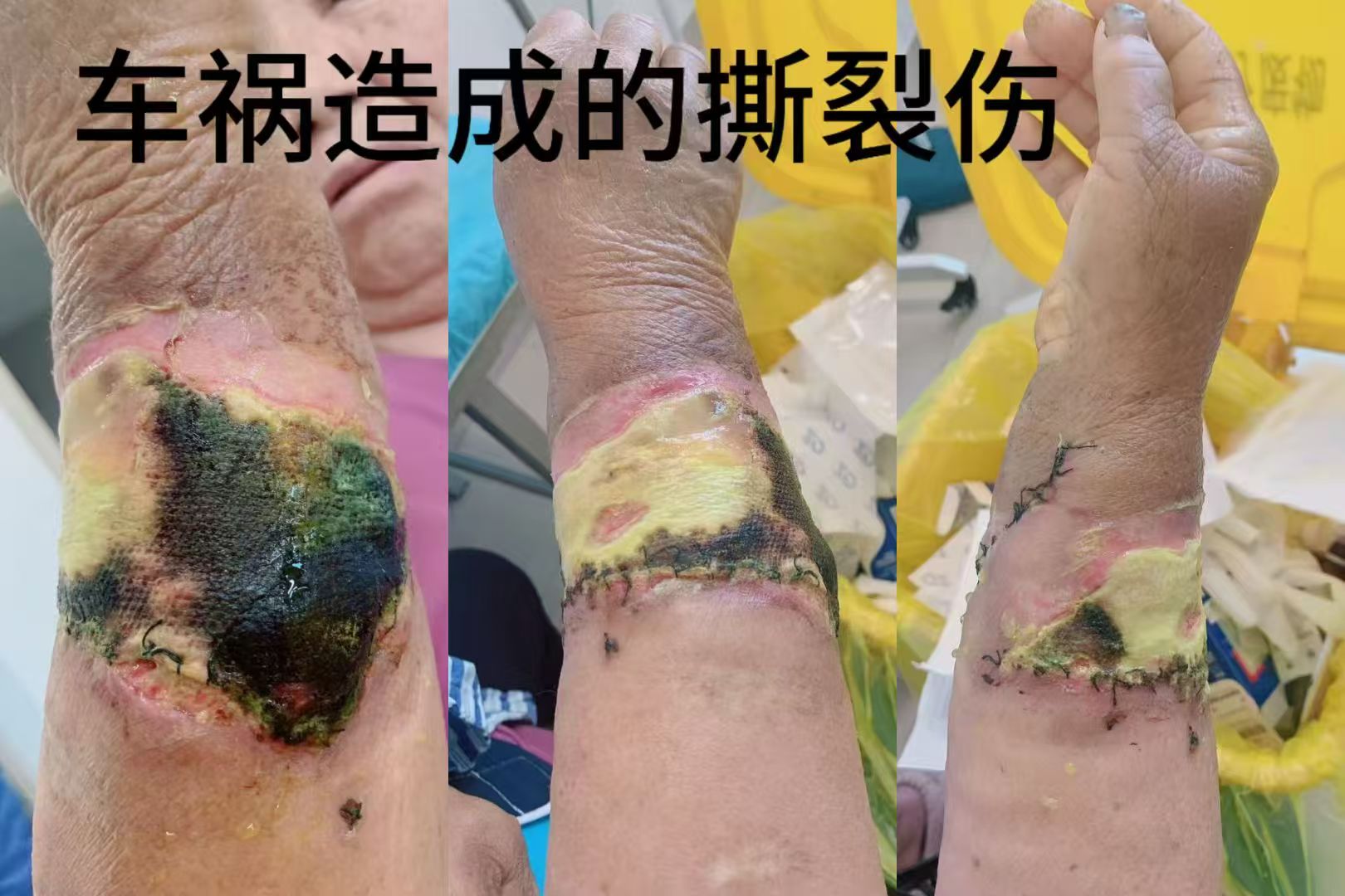 车祸造成的撕裂伤 治疗前照片